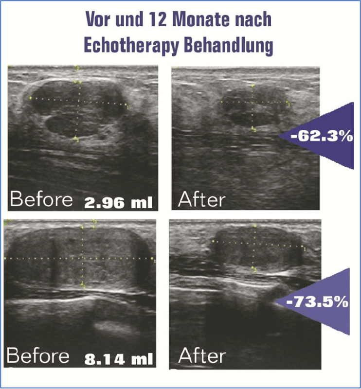 Fibroadenom vor und nach Echotherapie
