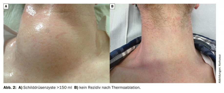 Rezidivierende Schilddrüsenzyste nach Behandlung