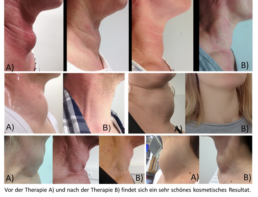 Kosmetische Ergebnisse vor und nach Schilddrüsen-Thermoablation